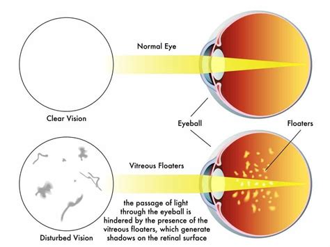 What Causes Floaters In Children S Eyes at Ronald Baugh blog