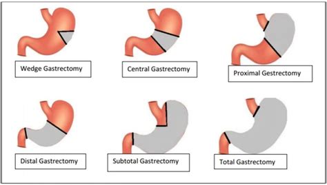 Gastric Cancer Surgery | Best Stomach Cancer Doctor in Chennai