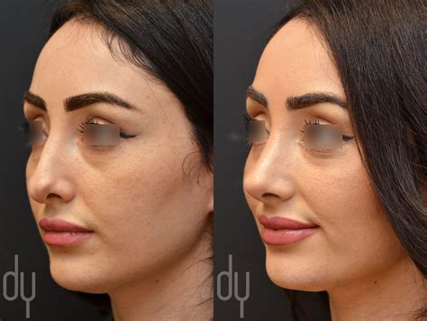 Beverly Hills Rhinoplasty Specialist Dr. Donald Yoo performed a revision rhinoplasty with ear ...