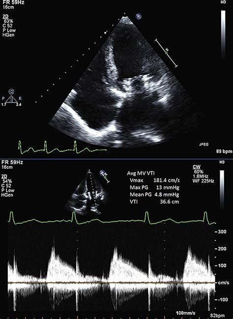 Post-Procedure Transthoracic Echocardiogram | Download Scientific Diagram