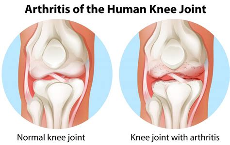 What is Involved in Kneecap Replacement Surgery?