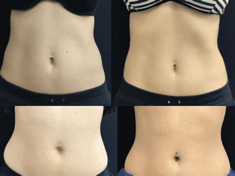 Emsculpt Before and After: An Effective Body Contouring Treatment