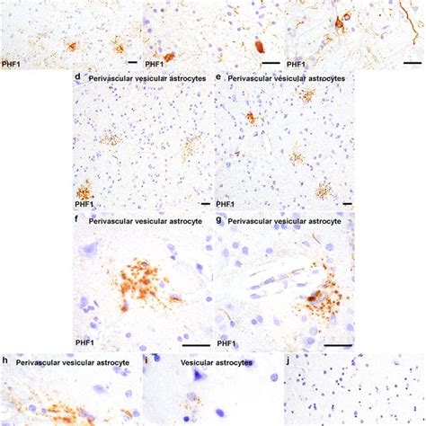 Immunotherapy treatment-related PVAs in corticobasal degeneration.... | Download Scientific Diagram