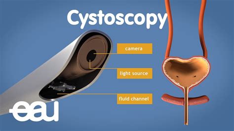 Cystoscopy (overactive bladder) - YouTube