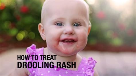 How to treat Drooling Rash - YouTube