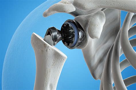 Joint Replacement | Lakeside Orthopedic