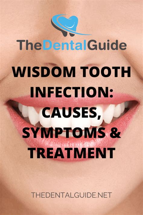 Wisdom Tooth Infection Causes Symptoms Treatment The Dental Guide Usa | My XXX Hot Girl