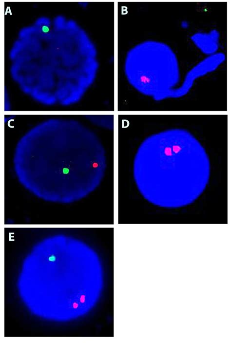 A Novel Sex Chromosome Mosaicism 45,X/45,Y/46,XY/46,YY/47,XYY Causing Ambiguous Genitalia