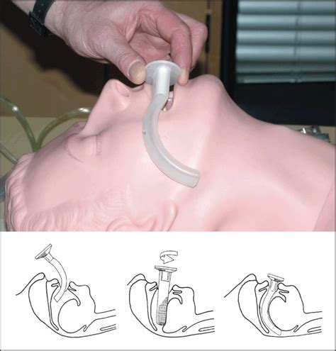 Airway management and ventilation | Obgyn Key