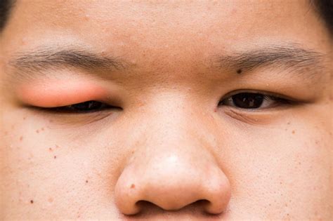 12 causes and treatments of a swollen eyelid: Stye, chalazion, allergies