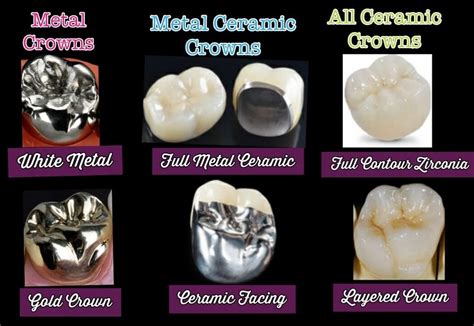 infinit chitară Lada zirconium vs metal ceramic crowns Recent a curăța Îmblânzi