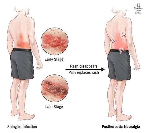 Postherpetic Neuralgia: Symptoms, Causes, Treatment & Prevention (2023)