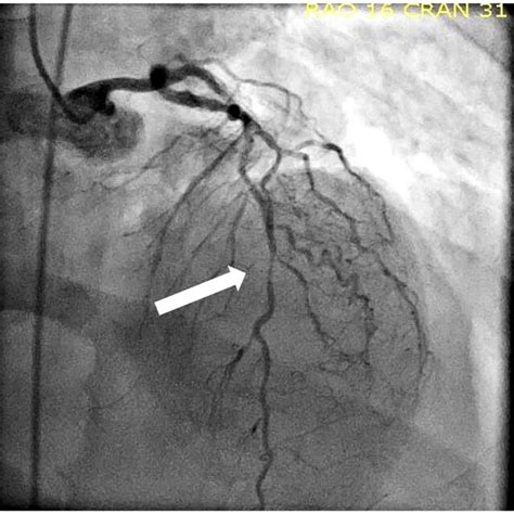 Coronary angiography after LIMA-LAD coronary artery bypass surgery ...