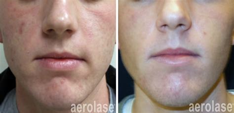 Aerolase Laser - Buckeye Dermatology