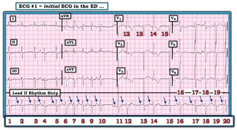 Dr. Smith's ECG Blog: Atrial fibrillation? Multifocal Atrial ...