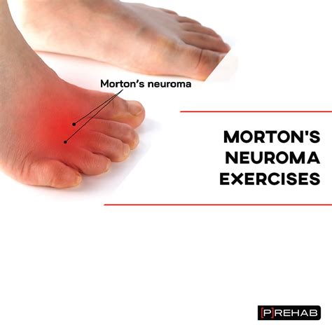 Morton’s Neuroma Exercises – INSTAGRAM Toe Exercises, Foot Stretches ...