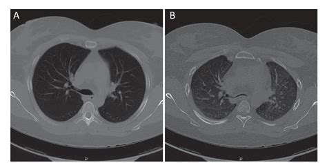 Figure 2 from Surgery for Tracheobronchomalacia | Semantic Scholar