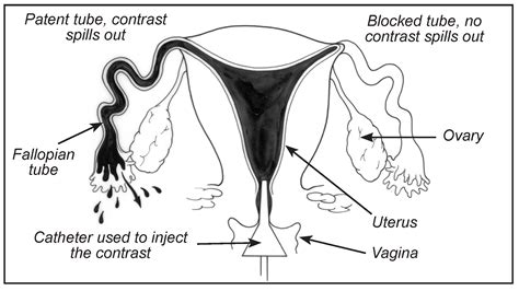 Hysterosalpingogram (HSG) patient education fact sheet ...