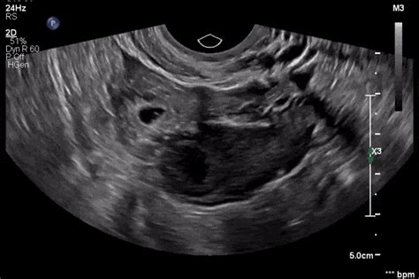 Ectopic pregnancy. Always perform the slide test to ... | GrepMed