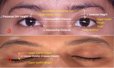 (a) Measurement with eyelid opened. (b) Measurement with eyelid closed ...