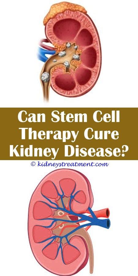 Pin on Kidney Disease Stages