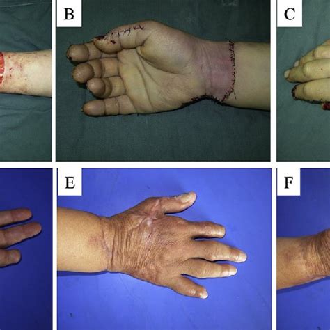 Total hand degloving injury (Case 1). (A) Before surgery. (B) Palm side... | Download Scientific ...