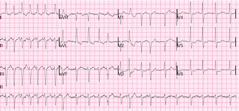 Surgeons Highly Recommend This Surgery for Atrial Fibrillati | Cardiology