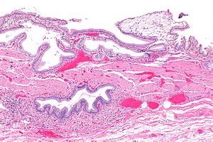 Chronic Cholecystitis Gross