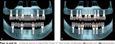 Classification of edentulous ridge - sadebamybest