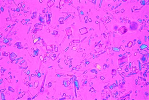 Identification of crystals in synovial fluid | Annals of the Rheumatic ...