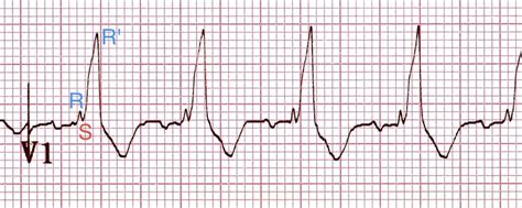 Right Bundle Branch Block Rbbb Litfl Ecg Library Diagnosis 59160 | The ...