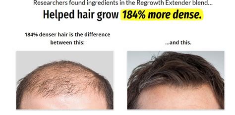 Best Hair Loss Treatments for Men: Proven Ways To Regrow Hair