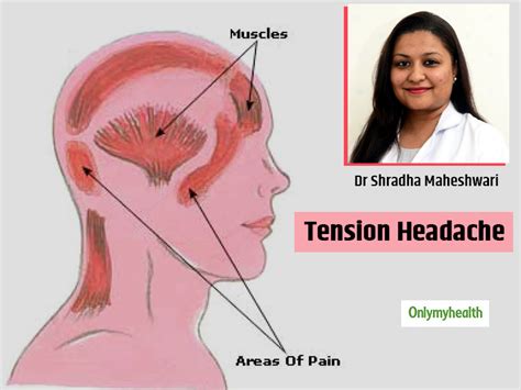What Is Tension Headache? Causes, Symptoms, Treatment And Pain ...