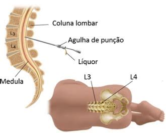 TAP test - Clínica Regenerati - Neurologia