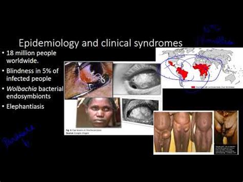 Onchocerca volvulus: characteristics, morphology, diseases - science - 2024