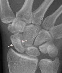 Scaphoid fractures — The Manchester Hand Clinic