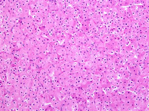 Pathology Outlines - Parathyroid adenoma