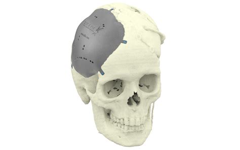 Xilloc Patient Specific implants - Maastricht Instruments