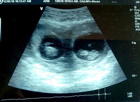 Ultrasound at 9+6 weeks showing bicornuate uterus with twin pregnancy... | Download Scientific ...