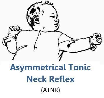 Tonic Neck Reflex - StatPearls - NCBI Bookshelf