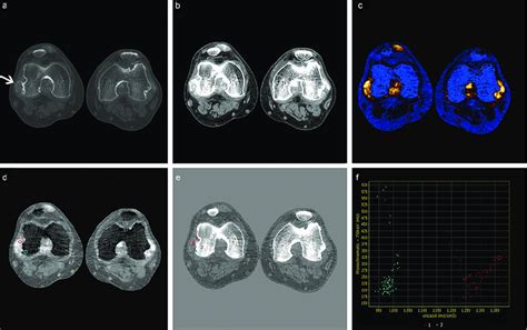 On conventional CT images (a: bone window, b: soft window), both ...