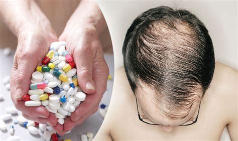 How to prevent hair loss? Expert reveals BEST anti-balding treatments | Life | Life & Style ...