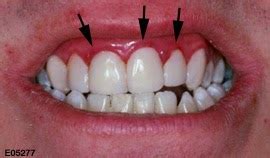 Swollen Gums (Causes, Symptoms and Treatment) – MedRition