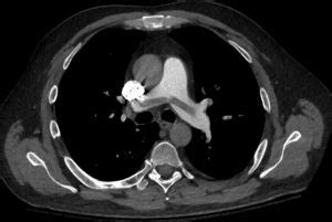 Saddle PE: Prevalence, Significance and Treatment Options