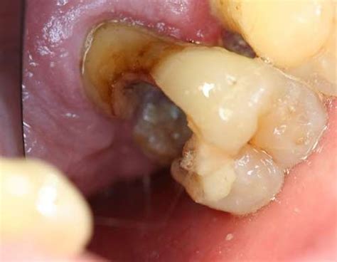 Flap's Dentistry Blog: The Daily Extraction: Upper Right Decayed Molar