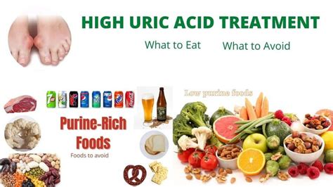 How to Treat Uric Acid Naturally : Diet and Recipes -NaturalCure ...