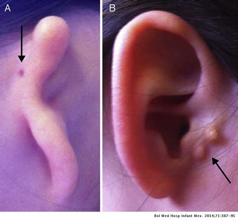 Microtia-atresia: aspectos clínicos, genéticos y genómicos | Boletín Médico del Hospital ...