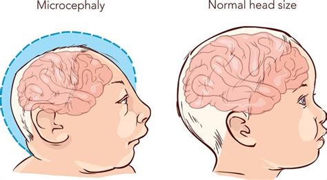 What types of complications are associated with the Zika virus?