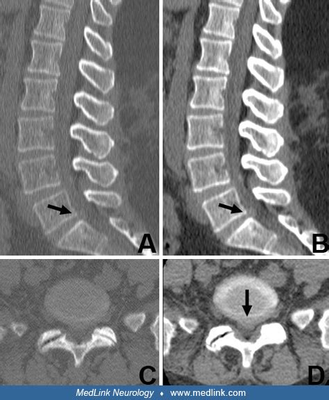 Lumbar Disc Disease Mri