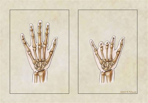 Red right hand: Ectrodactyly as a metaphor - Hektoen International